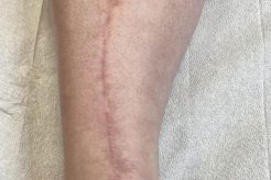 Top 50 Scar Tattoo Ideas For Men: A Guide Meaningful Tattoos: Symbols with Deep Personal Significance Top 50 Scar Tattoo Ideas For Men: A Guide | Meaningful Tattoos: Symbols with Deep Personal Significance