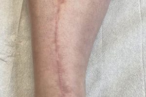 Top 50 Scar Tattoo Ideas For Men: A Guide Meaningful Tattoos: Symbols with Deep Personal Significance Top 50 Scar Tattoo Ideas For Men: A Guide | Meaningful Tattoos: Symbols with Deep Personal Significance